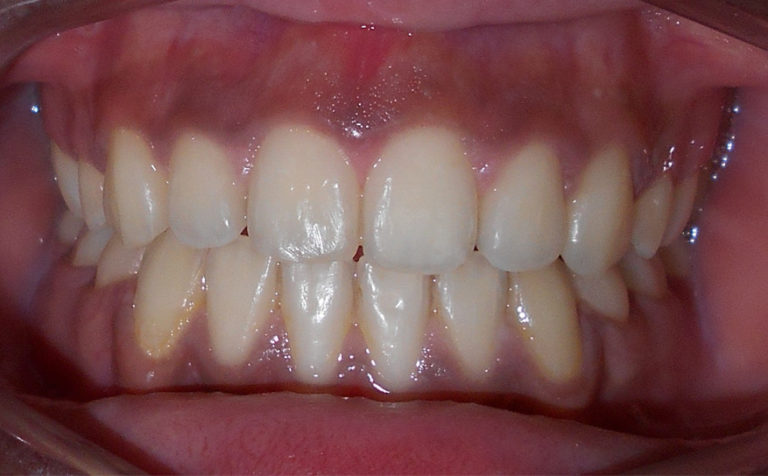 Adolescent de 12 ans présentant un encombrement maxillaire et mandibulaire, Situation après traitement orthodontique