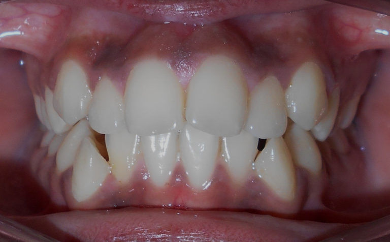 Adolescent de 12 ans présentant un encombrement maxillaire et mandibulaire