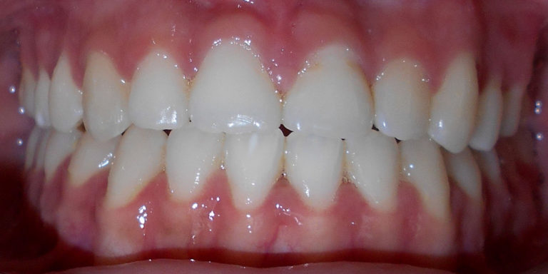 Situation après traitement orthodontique réalisé conjointement avec un spécialiste en chirurgie maxillofaciale
