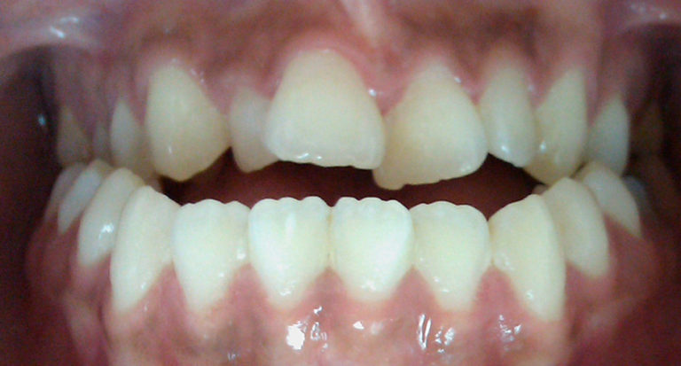 Correction d’un décalage sagittal d’une jeune adulte : mâchoire du haut trop petite, les dents du haut s’emboitent à l’intérieur des dents du bas